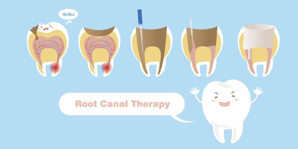 A Basic Guide What is a Nonsurgical Root Canal?