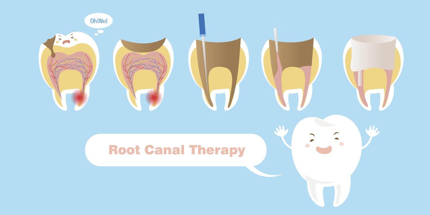 Root Canal Therapy - Dental Treatment in Warrenville