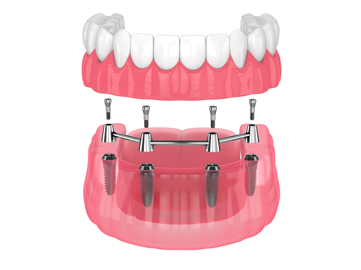 Removable overdenture installation on bar clip attachment, supported by implants