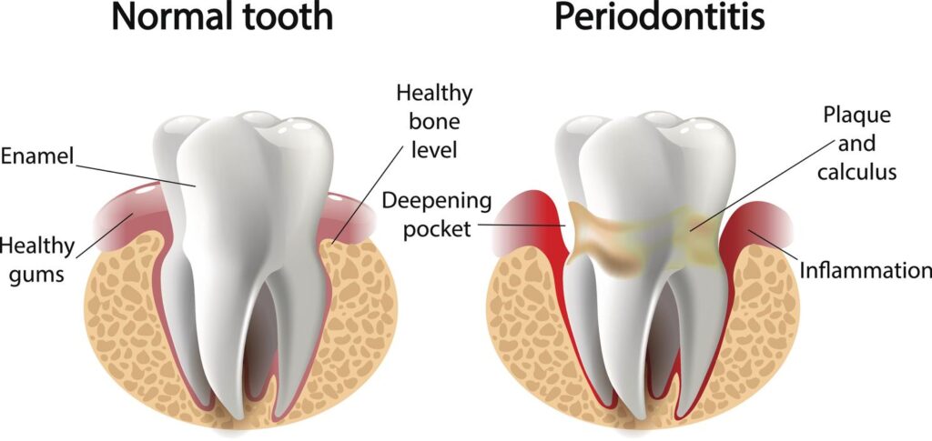 Gum Disease and Its Link to Your Heart and Brain