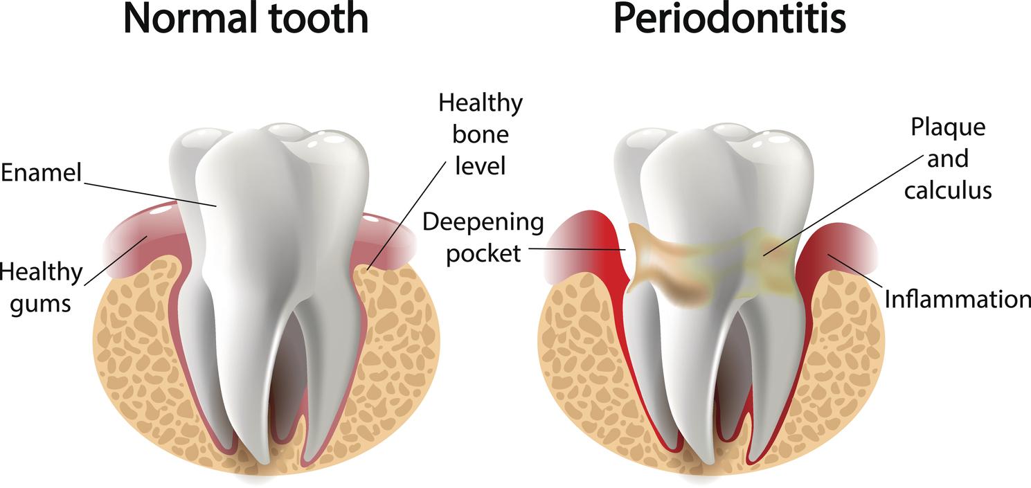 Infogrpahic – Difference between normal tooth and periodontitis