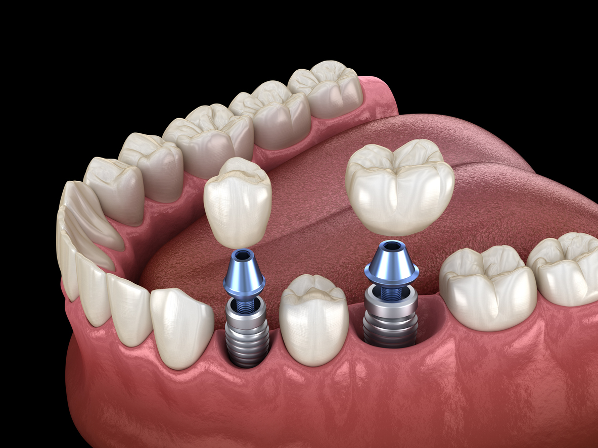 Replacing Missing Teeth with Dental Implants